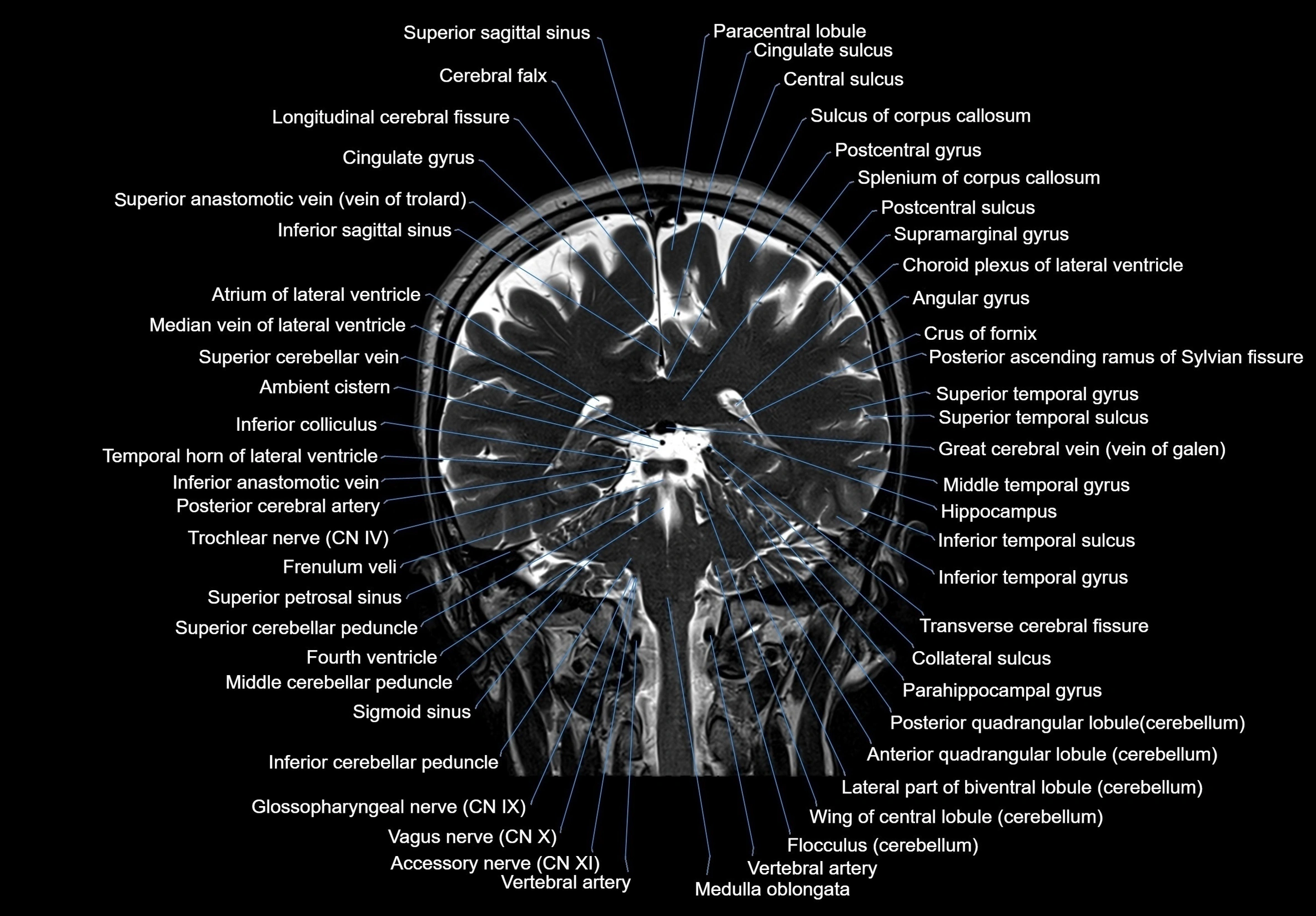 MRI Brain coronal cross sectional labelled anatomy 3T image  -img-00001-00048.webp